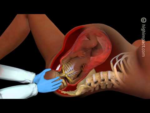 Brachial Plexus Injury