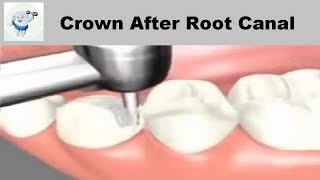 Dental Crown Procedure After Root Canal