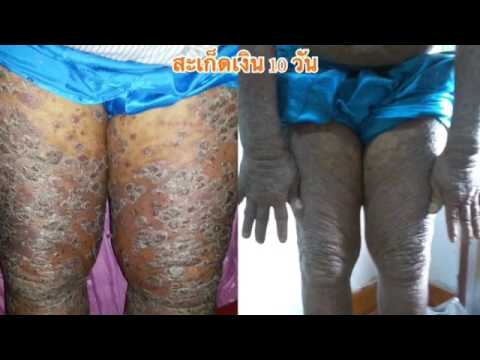 อาบน้ำที่มีการสืบทอดของ neurodermatitis อาหารการรักษาสำหรับโรคสะเก็ดเงิน