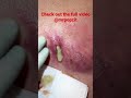 Large Double Wide Abscess. See full video - https://youtu.be/E6tX-3t1-QE?si=-wX831ckhRxvBd4O
