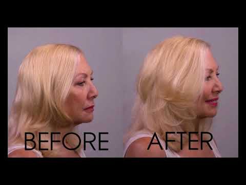 Hair Loss Solutions for Men and Women