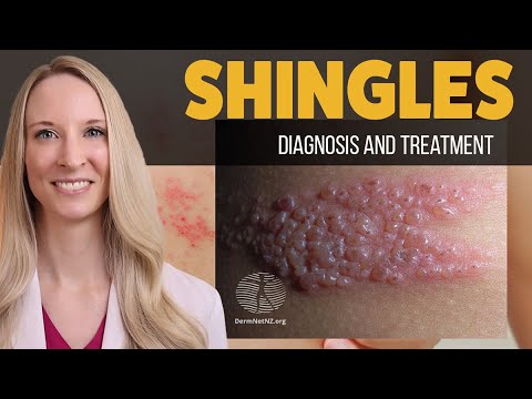 Shingles (Herpes Zoster): Diagnosis, Treatment, Prevention, and Complications. Dermatology Deep dive