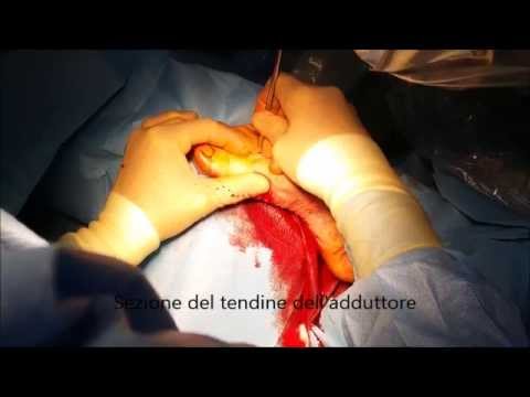Osteocondrosi del codice toracico cervicale in CIM 10 Come trattare la displasia dellanca nei neonati Video