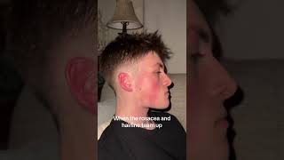 There’s worse things in the world #rosacea #skin #rosceaskin #rosaceaawareness #rosaceacheck