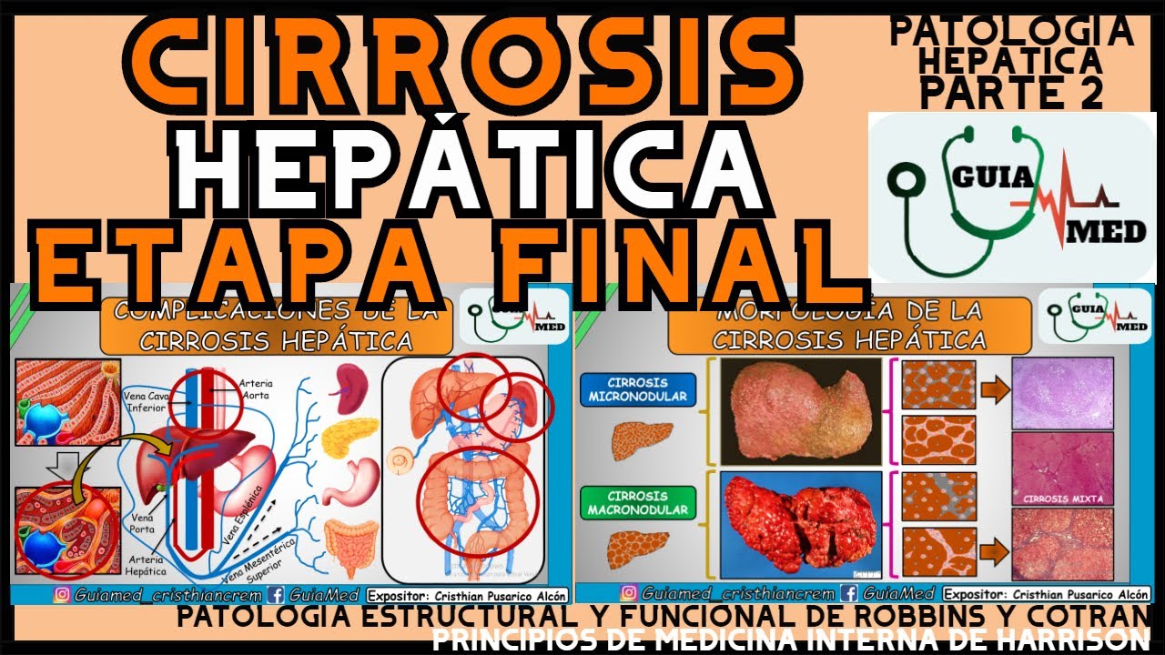 CIRROSIS HEPÁTICA ETAPA FINAL | GuiaMed