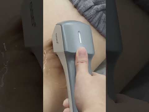 Diode Laser Hair Removal | Fast, Safe & Painless