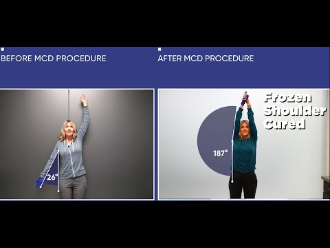 Failed Cortisone, Shockwave, and Hydrodilation — Frozen Shoulder Gone in 2 Days