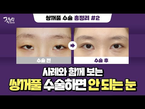 이런 눈 형태를  갖고 있다면 쌍수 지금 당장 멈춰!❌
