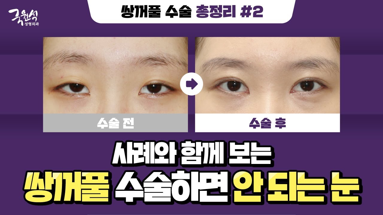 이런 눈 형태를  갖고 있다면 쌍수 지금 당장 멈춰!❌ - 추천 영상