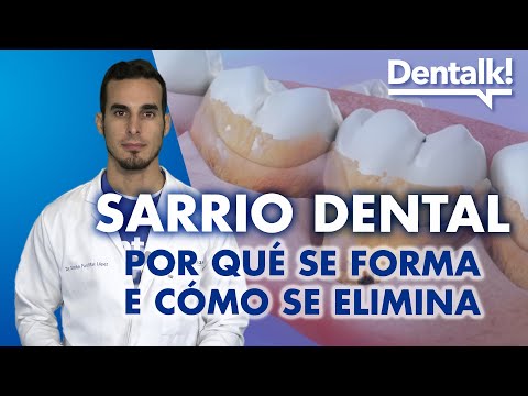 Vídeo: Tártaro ou sarrio nos dentes