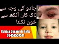 Nose Ear Eye Bleed Causes Blackmagic Treatment With Quran Dam Rukiya Qurani Dr Hafiz Urdu Hindi