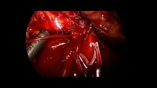 Management of intraoperative bleeding during lap right colectomy performed by a surgical trainee