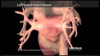 Effects of congestive heart failure