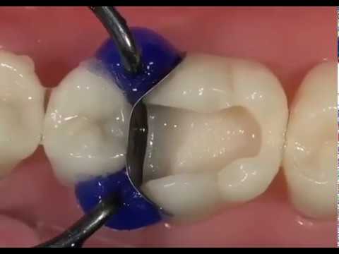 White composite filling a molar
