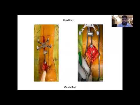 Dr Shailesh R Hadgaonkar - Accuracy of O arm Navigation Pedicle screw in Various spinal Pathologies