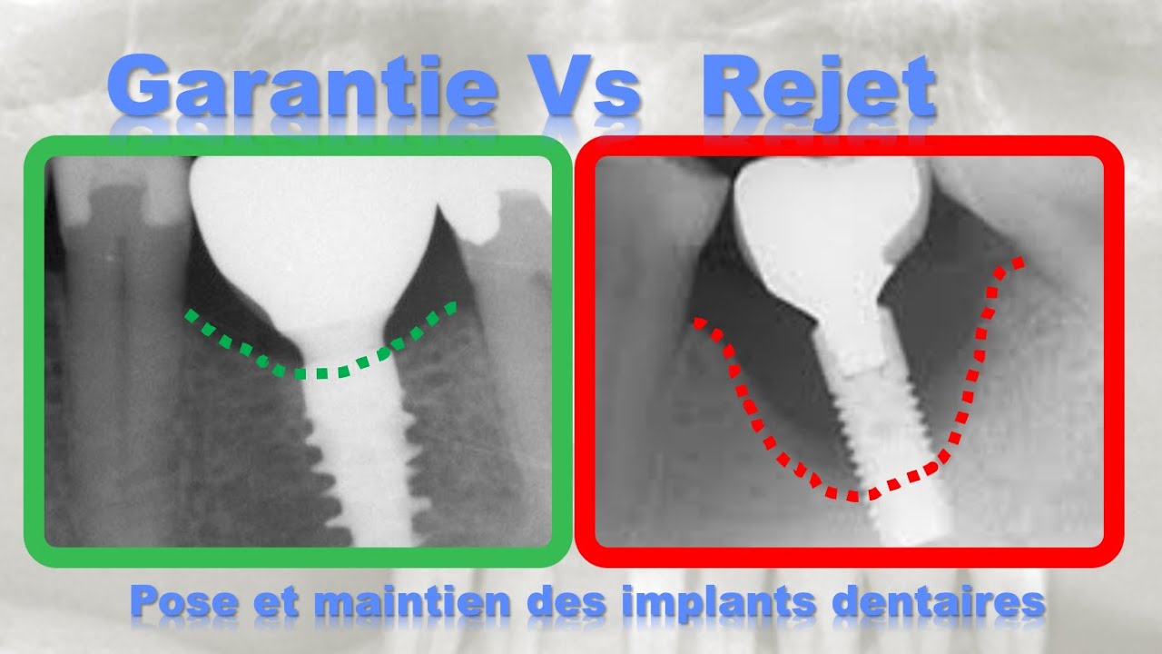 Garantie implant dentaire pose et maintien