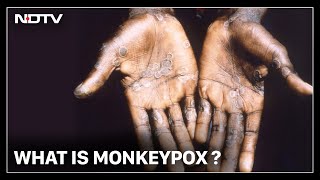 What Is Monkeypox? | Hot Mic with Nidhi Razdan