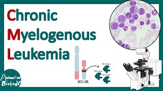 Chronic Myelogenous Leukemia (CML)  | Pathology of CML | Diagnosis and treatment of CML | USMLE