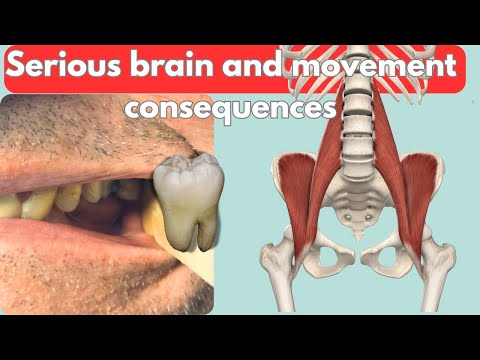 How Malocclusion Influences Your Brain and Movement