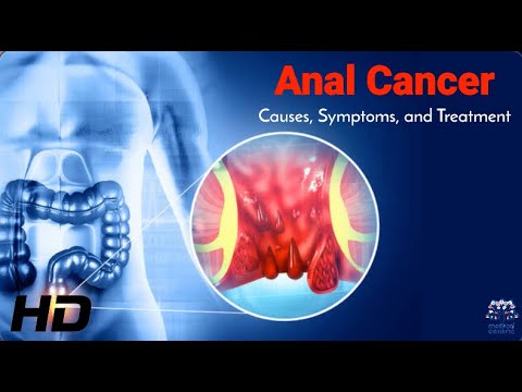 Anal Cancer Facts: What Causes It and How to Fight It
