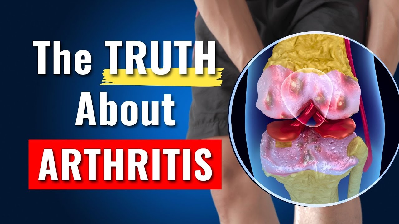 8 Common Knee Osteoarthritis Myths Debunked