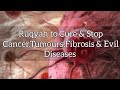 Very Powerful Ruqyah To Cure Stop Renewing The Growth Of Cancer Tumours Fibrosis All Evil Diseases