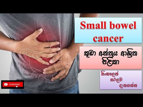 Small bowel cancer | කුඩා අන්ත්‍රයේ පිලිකා | #cancer | how to treat