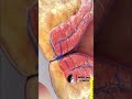 Cirurgia De Hemorróida Shorts