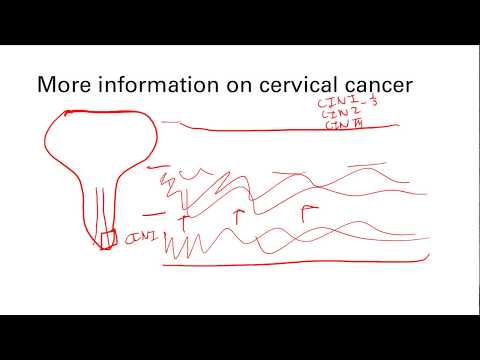 Sarcoma cancer liver