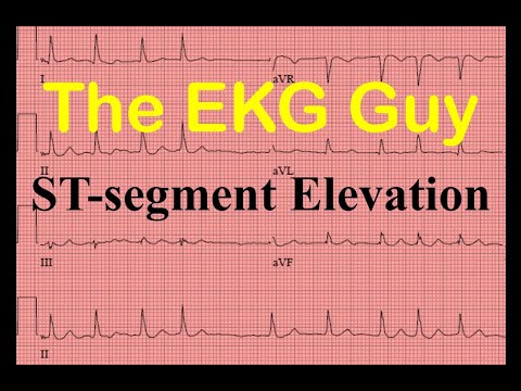 EKG/ECG ST-segment Elevation - Question 9.0 | The EKG Guy