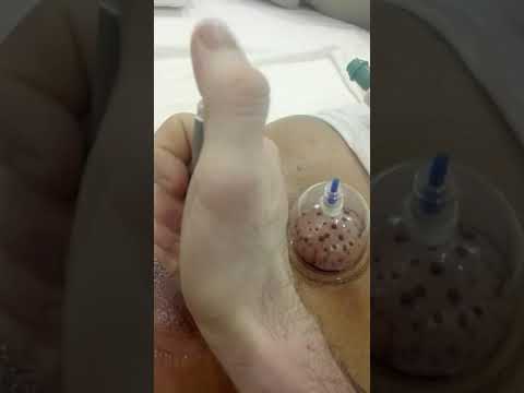 Hijama cupping acupuncture needles pen