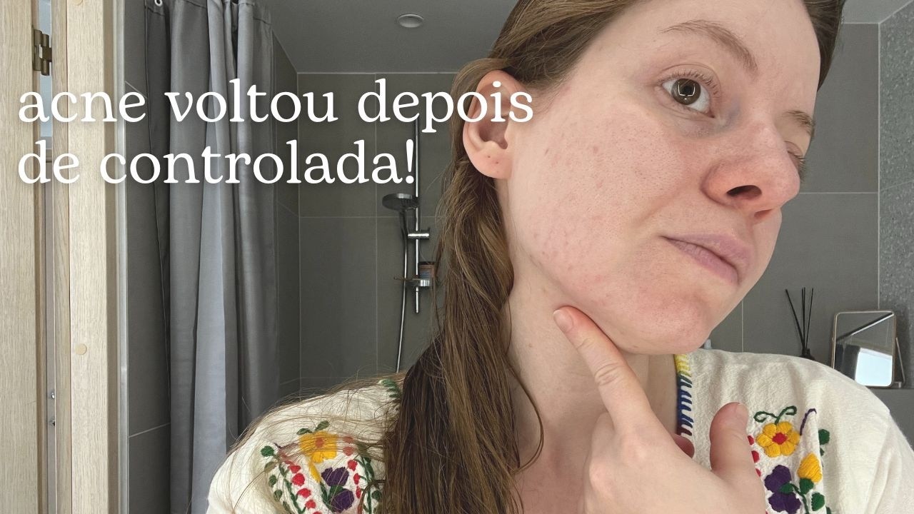 Rotina de Skincare para Tratar um Surto de Acne