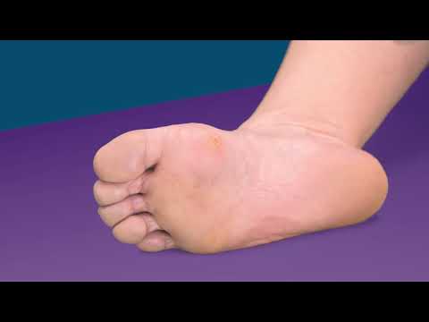 Video   Excilor Warzenbehandlung 2in1