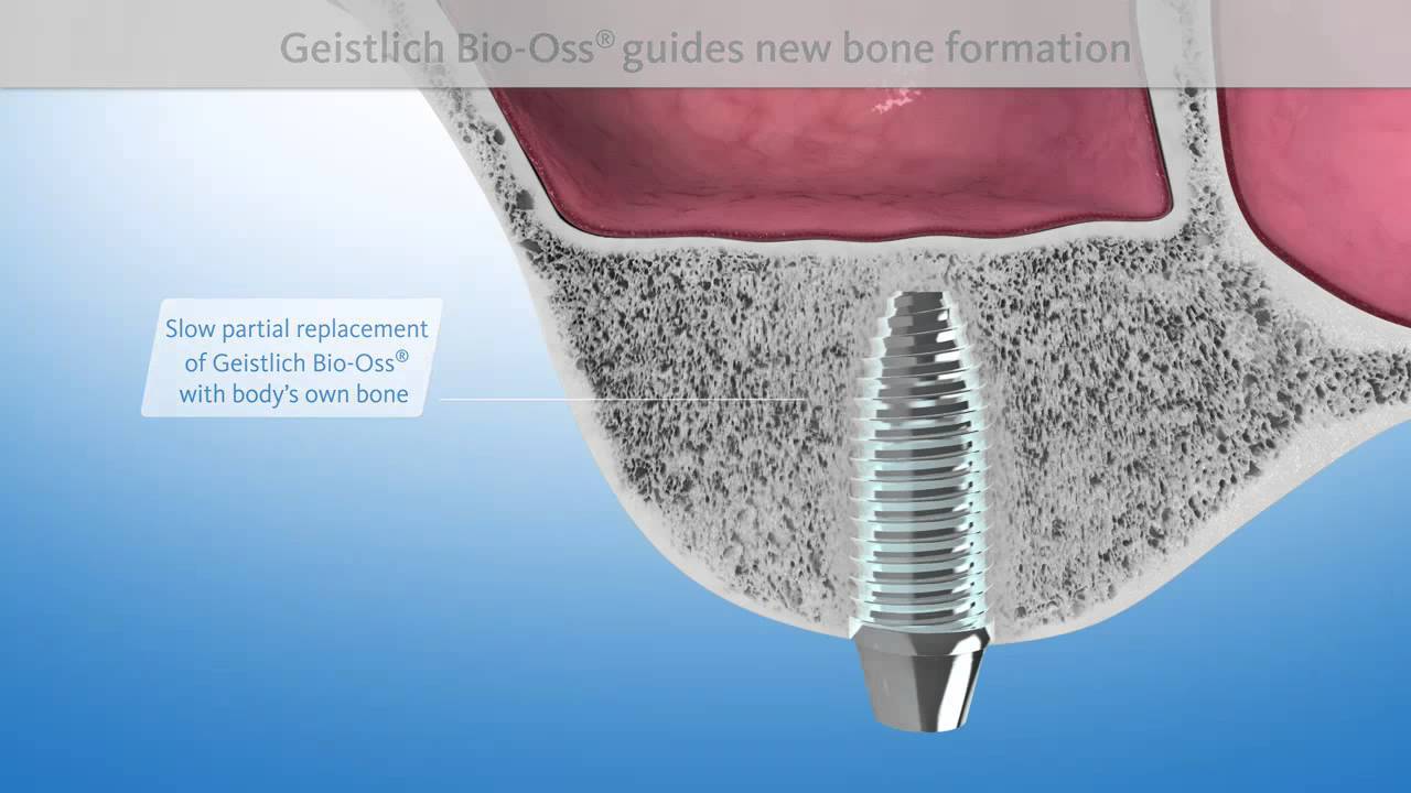Geistlich Patient Information sinus floor elevation EN