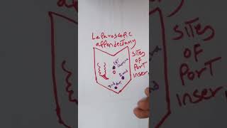 LAPAROSCOPIC APPENDECTOMY -PORT SITE