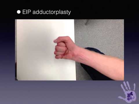 1 minute masterclass: EIP adductorplasty for combined high ulnar and median nerve injury