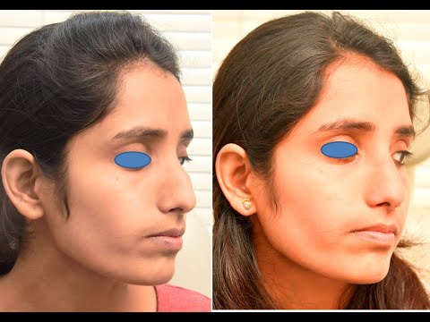 Component Hump reduction -How I do it