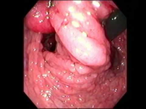 Full Colonoscopy -  Familial Adenomatous Polyposis in Colon