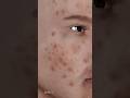 What Exactly Is Acne, Causes of Acne: 3D Animation