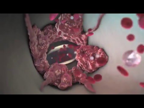 What Are the Symptoms of a Blood Clot in Your Lung? | WebMD