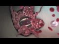 What Are The Symptoms Of A Blood Clot In Your Lung WebMD
