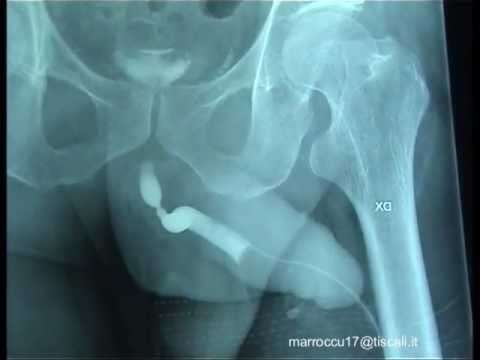 Prezzi prostanorm in Crimea Cause di prostatite cronica