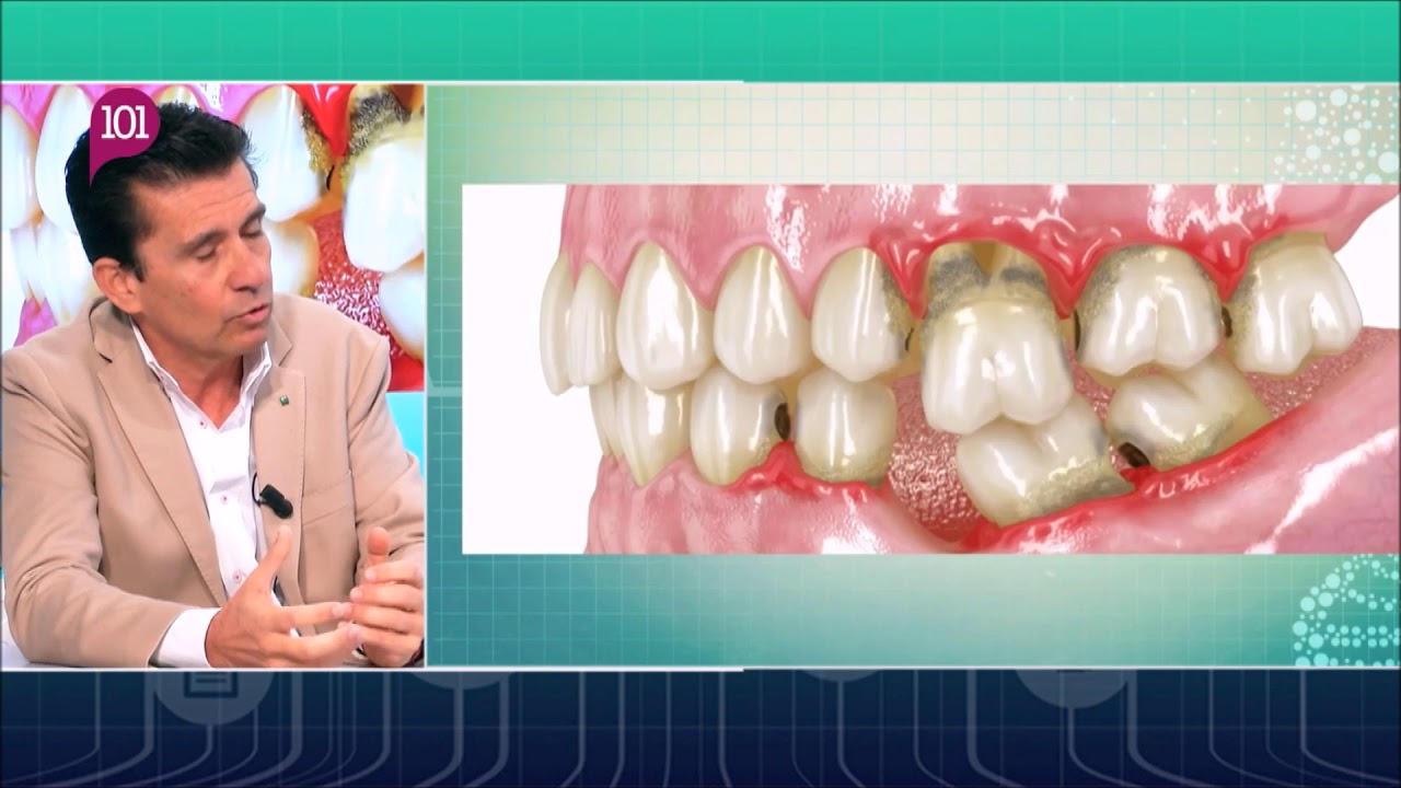 Dr. Cuevas responde -5- Regeneración, Preservación, Pérdida de hueso- Clínica Dental Cuevas Queipo
