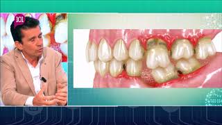 Dr. Cuevas responde -5- Regeneración, Preservación, Pérdida de hueso- Clínica Dental Cuevas Queipo