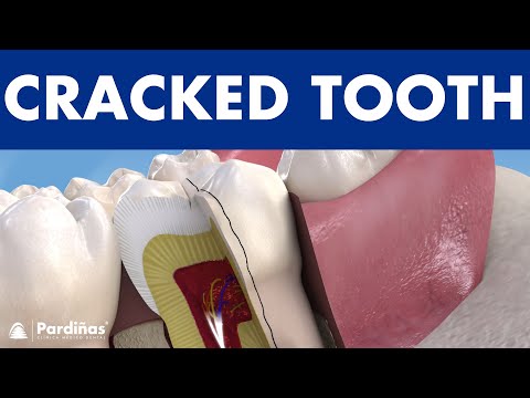 Chipped and CRACKED TOOTH  - How do teeth break? ©
