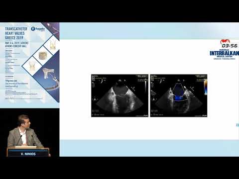 V. Ninios  | An often Challenging MitraClip Decision: Whether to Implant a second (or third) Clip