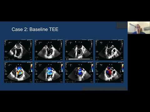 2022: Transcatheter Mitral Valve Replacement (TMVR): the Medtronic Intrepid system