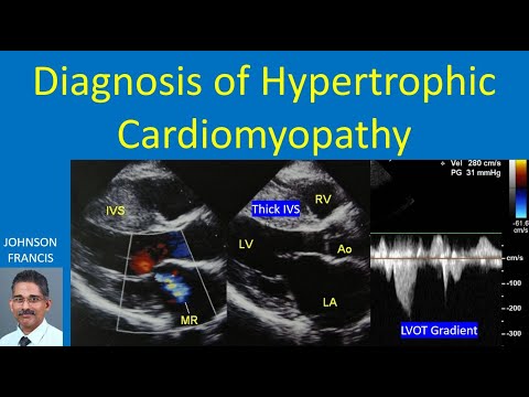 Diagnosis of Hypertrophic Cardiomyopathy