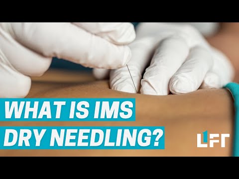 IMS Dry Needling With Your Vancouver Physiotherapist - Everything You Need to Know