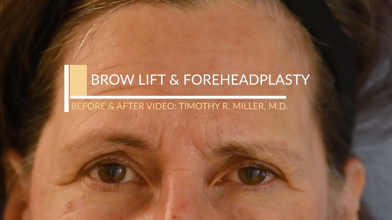 Before & After Brow Lift in Orange County With Dr. Timothy Miller